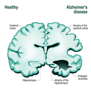 Brain with Alzheimer's