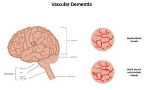 Vascular Dementia